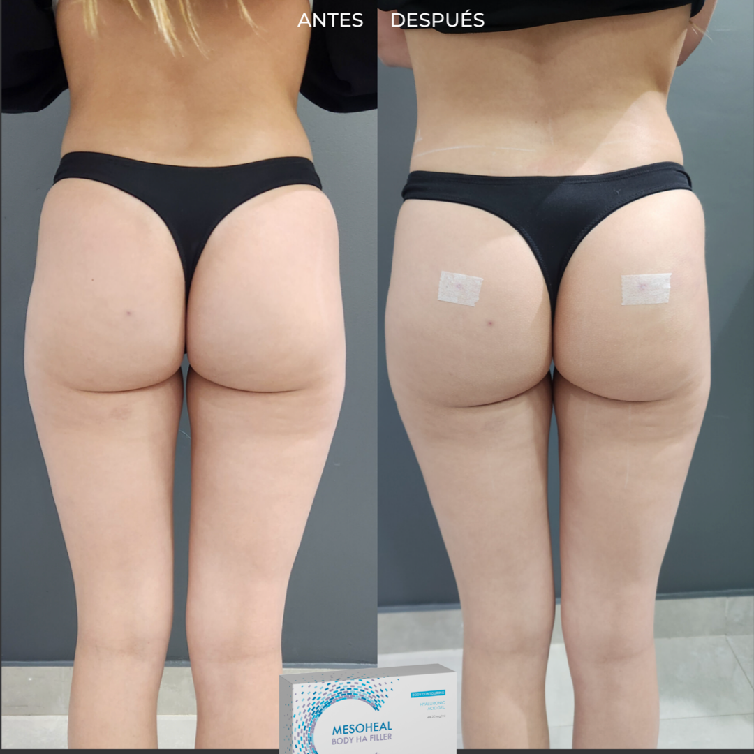 Mesoheal Body Filler